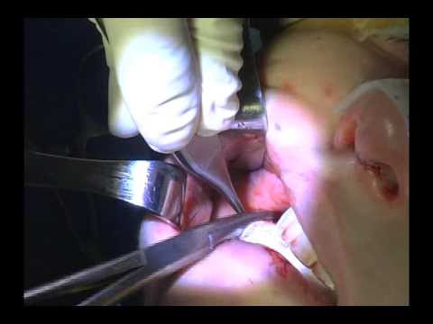 buccal removal