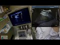 hepatic biopsy