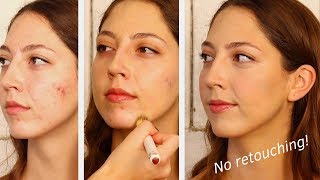 How to Cover Acne & Scars and Still Look Natural