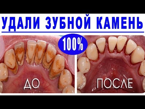 Как можно убрать камень на зубах в домашних условиях Как можно убрать камень на зубах в домашних условиях