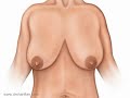 انیمیشن جراحی زیبایی سینه با برش بزرگ
