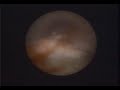 Revealing Perioscopy Video demonstrates the truth about why blind root planing doesnt work!