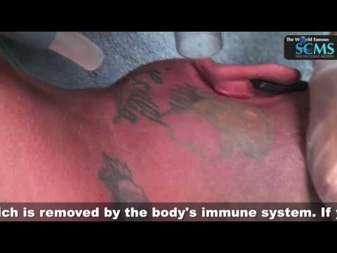 Laser Tattoo Removal Neck Former Gang Banger rehabilitated by SCMS