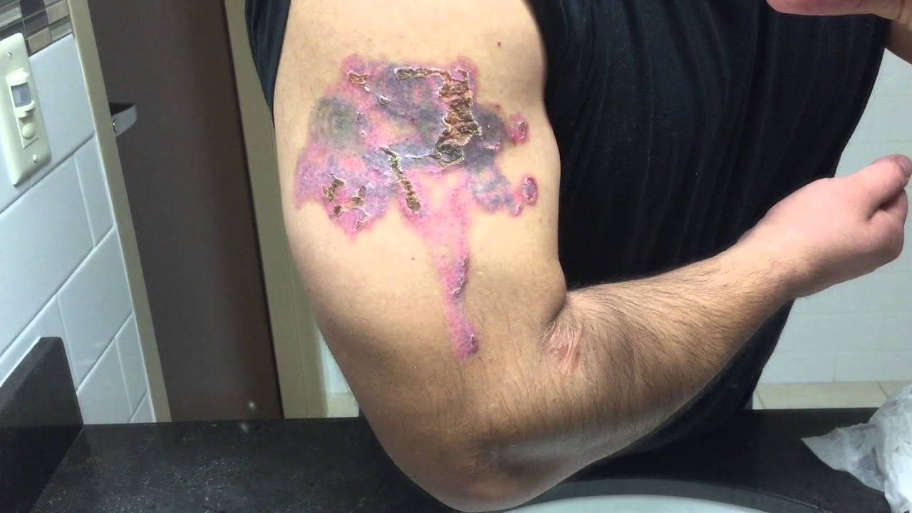 TCA 50% Tattoo Removal - Day 13 - YouTube