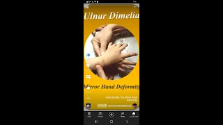 Ulnar Dimelia, The Mirror Hand Deformity
