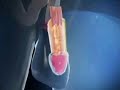 agrandissement penis