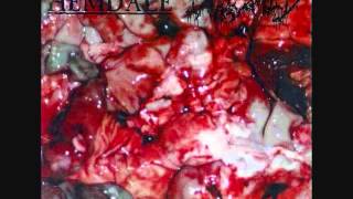 Watch Exhumed Dissecting The Caseated Omentum video