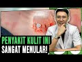 Penyakit Kulit Ini Sangat Menular (Scabies/Kudis)