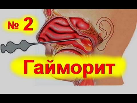 Быстрое лечение гайморита в домашних условиях Быстрое лечение гайморита в домашних условиях