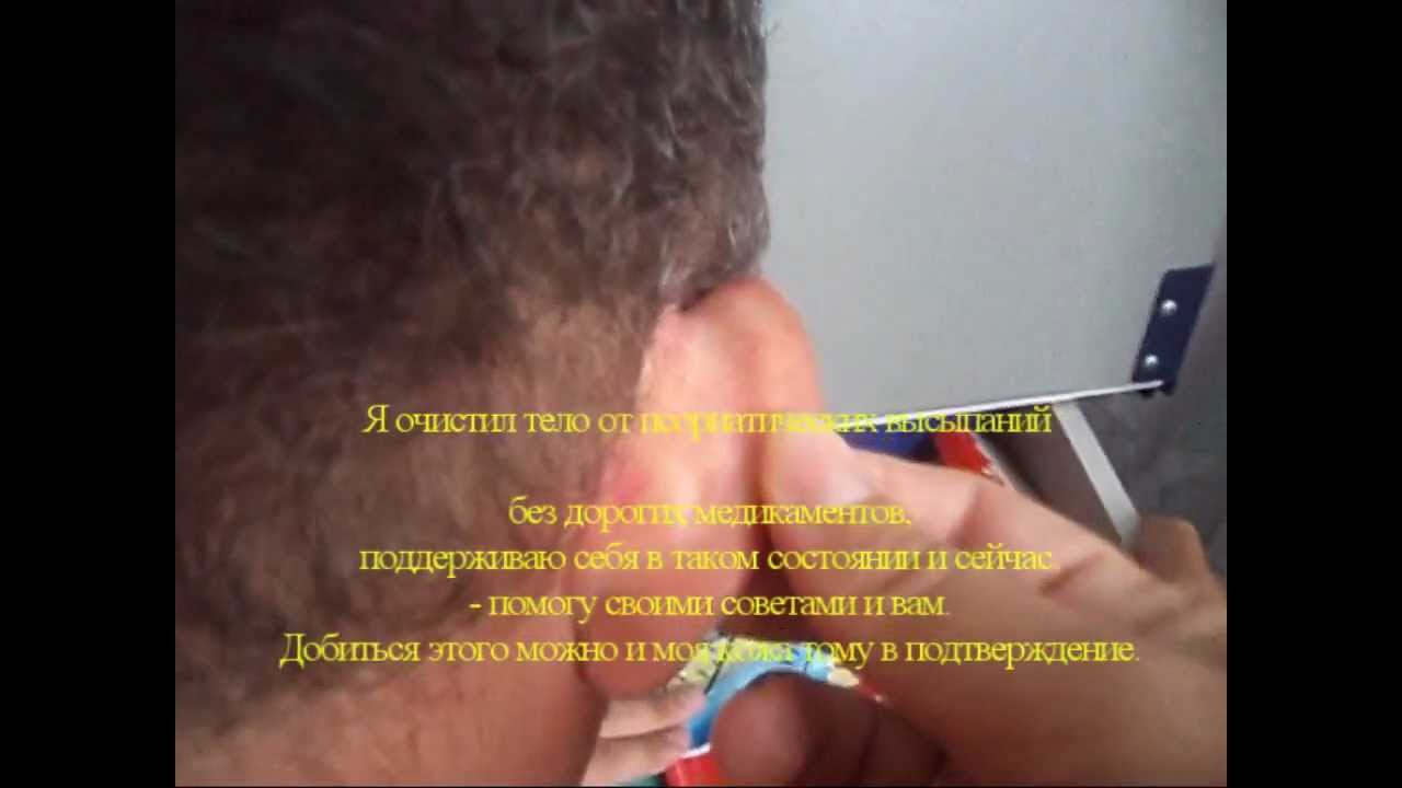 Псориаз лечение в домашних условиях рецепт