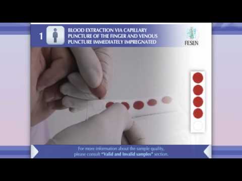 Blood extraction via capillary puncture of the finger and venous...