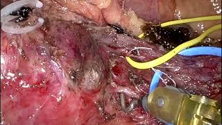 Robotic Enucleation Of Pancreatic Solid Pseudopapillary Neoplasm Of The Uncinate Process.