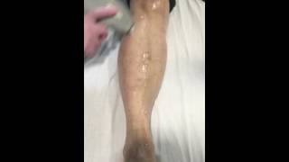 Palm Beach Laser Hair Removal - Quick & Painless!
