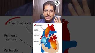 Tetralogy Of Fallot Tof