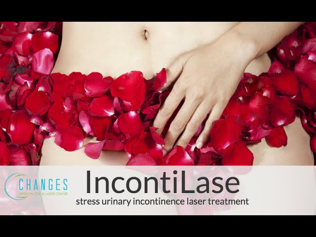 IncontiLase for Urinary Stress Incontinence