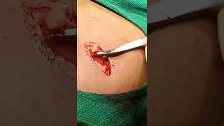 Its Operation Of Normal Nonadherant Open Appendicectomy
