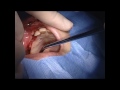 香川丸亀TOSHIO Zygoma implant  into maxillary sinusitis