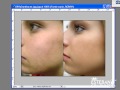 Photoshop Cs4 - piel de seda Y borrar manchas