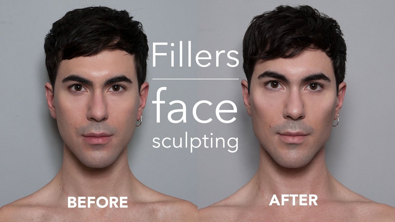 Facial sculpting surgery