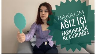 Salya Kontrolünün Tedavisi Için Masaj Tekniği Mage Technique For Saliva Treatment