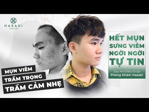Hasaki.vn - Hết Mụn Sưng Viêm Sau Thuốc Rượu & Trị Mụn Không Đúng Cách | Khách Hàng Thực Tế