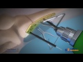 Distal Femoral Osteotomy Animation #3 Distal Femoral Osteotomy Animation #2