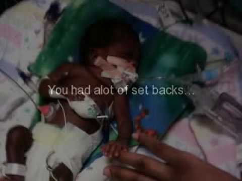 Premature Baby Archie Premature Baby Archie