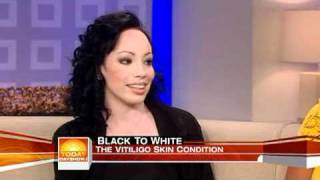 Girl with vitiligo talks about Michael Jackson Girl with vitiligo talks about Michael Jackson