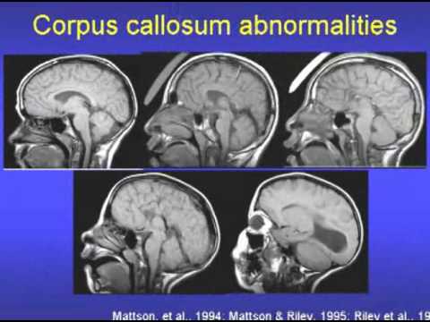 Fetal Alcohol Syndrome & Fetal Alcohol Effects Video Part 1 - YouTube