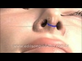 brazil plastic surgery