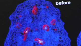 SPECT scan pre post Neurofeedback on PTSD
