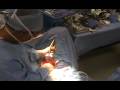 Colon Surgery
