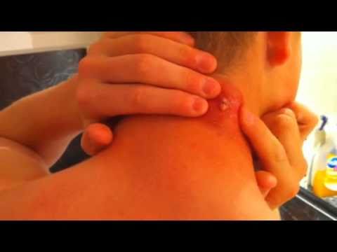 how to get an abscess to burst how to get an abscess to burst