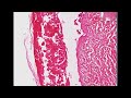 Histopathology Skin--Varicella (chicken pox)