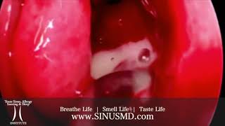 LEFT MAXILLARY SINUS PUS AND IN OFFICE BALLOON MAXILLARY AND FRONTAL SINUPLASTY