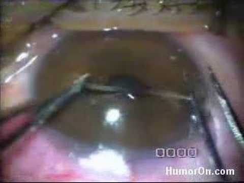 WORM LIKE CREATURE REMOVED FROM EYE