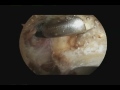 Acetabular Labral Repair with Takedown and Femoral Neck Resection