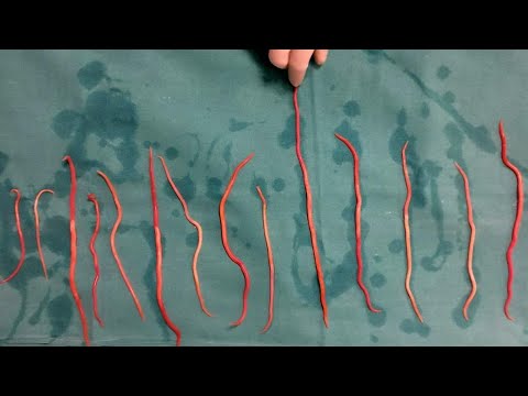 Doctors Remove 14 Roundworms From Woman