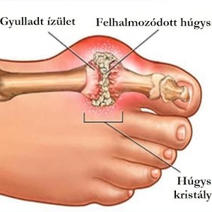 ízületi betegség szérum