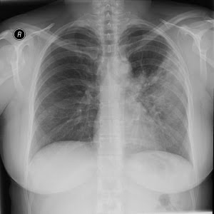 Left Atrial Enlargement On Chest X Ray Radiology Video Tutorial Youtube