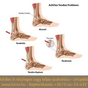 achilles tendonitis magyarul