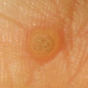 木酢液クリアの付け方 ウイルス性イボ 約3か月で完治した Youtube 木酢液クリアの付け方 ウイルス性イボ 約3か月で完治した Youtube