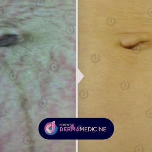 8erapeia Ragadwn Me Fractional Laser H Dermatologos Dr Amalia Tsiatoyra Mas Enhmerwnei Youtube