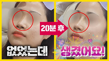 실제 코필러 시술영상! 20분만에 없던 콧대가 생겼다? - 필러와 코 실을 이용한 쁘띠 코 성형!