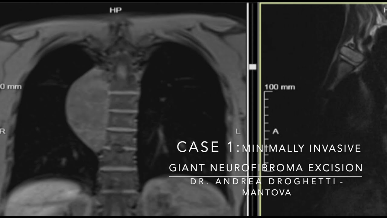 Giant Neurofibroma Excision in Minimally Invasive Thoracic Surgery