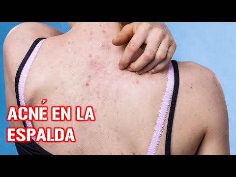 Luce una espalda sin granos (acné)