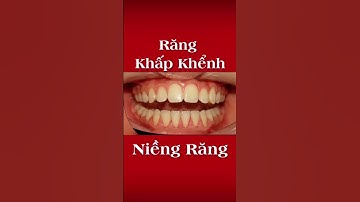 Niềng Răng Khấp Khểnh Lệch Lạc