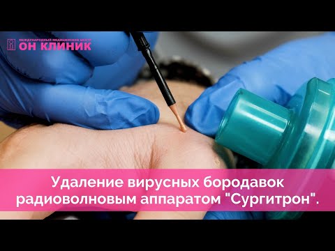 Удаление вирусных бородавок радиоволновым аппаратом "Сургитрон" в ОН КЛИНИК.
