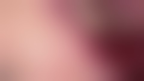 simple 3 D ridge augmentation using SANTA and Sticky Bone