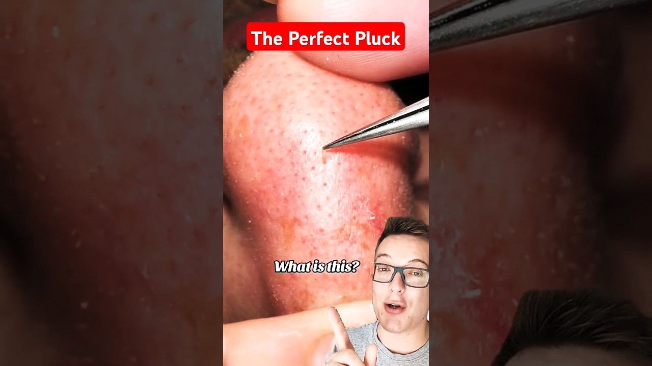 What Is This - SEBACEOUS FILAMENT BLACKHEAD REMOVAL #shorts